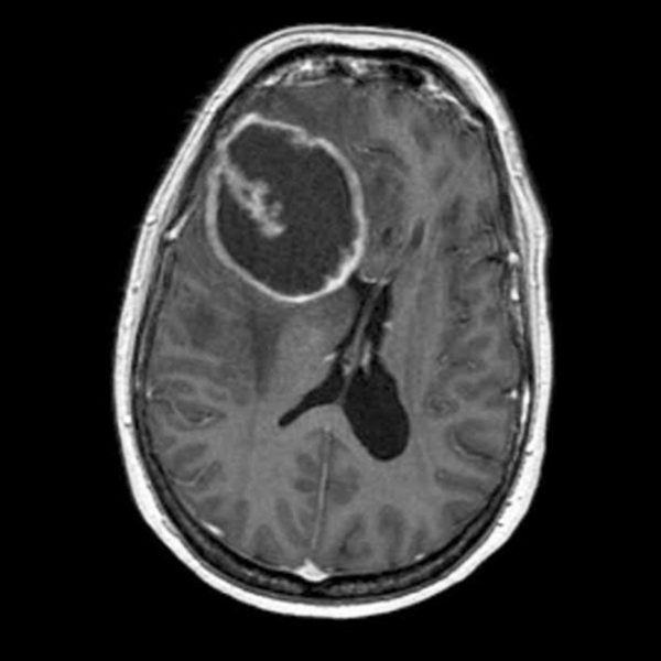 MRI example classified as glioma