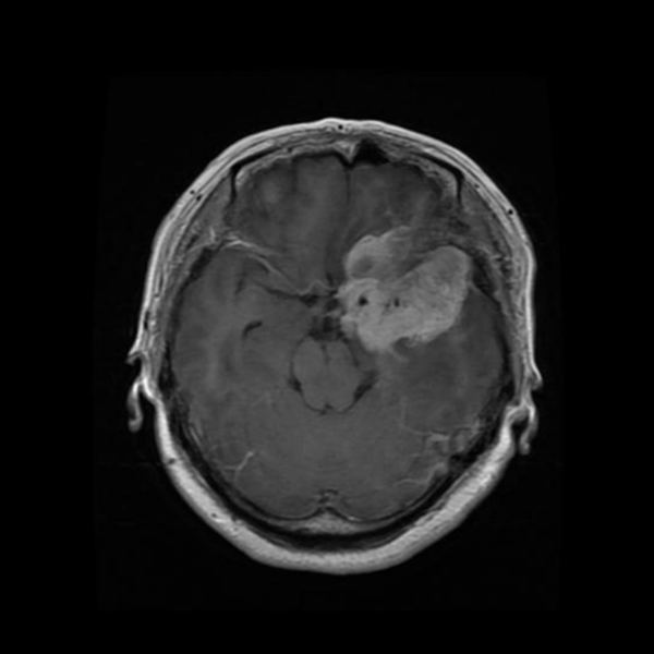 MRI example classified as meningioma