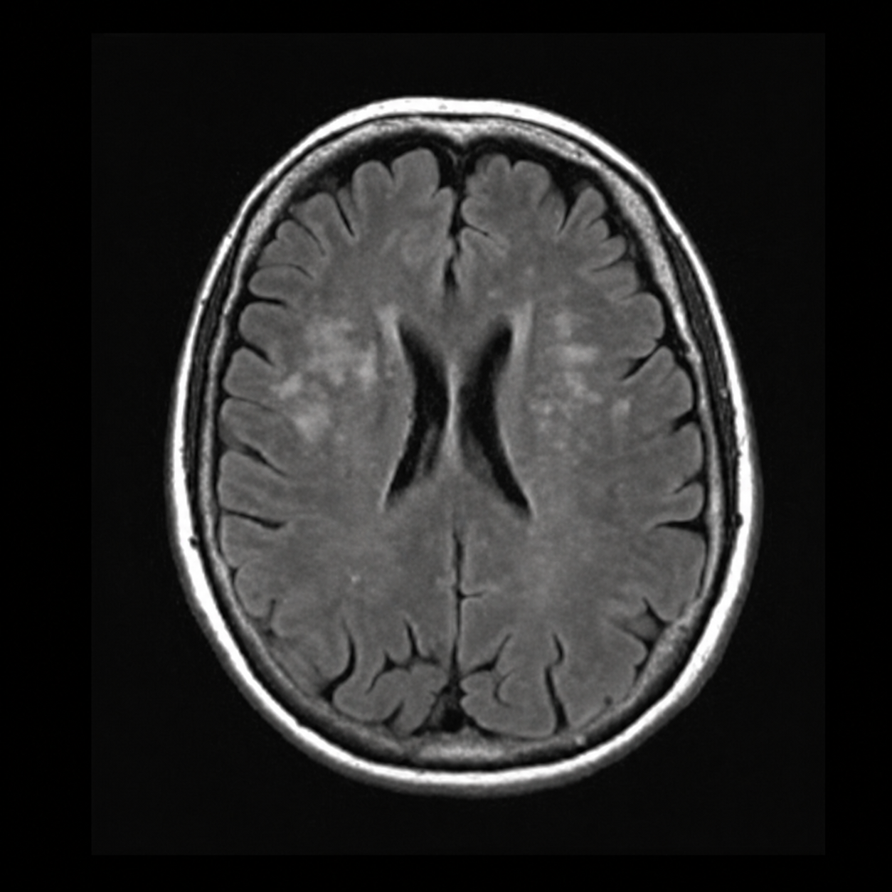 MRI example classified as no tumour