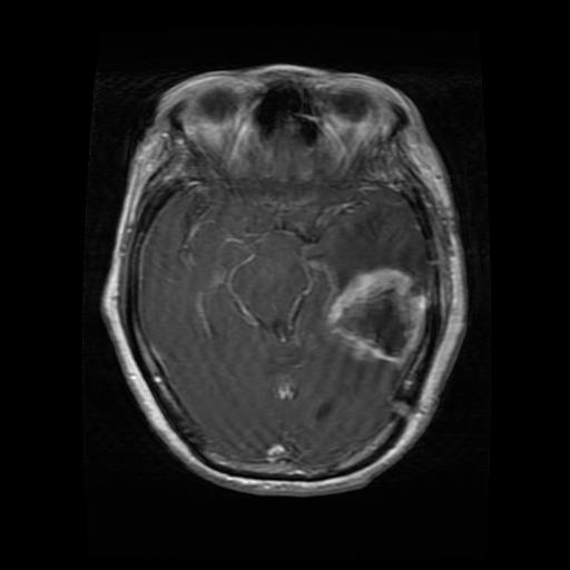 MRI example classified as pituitary