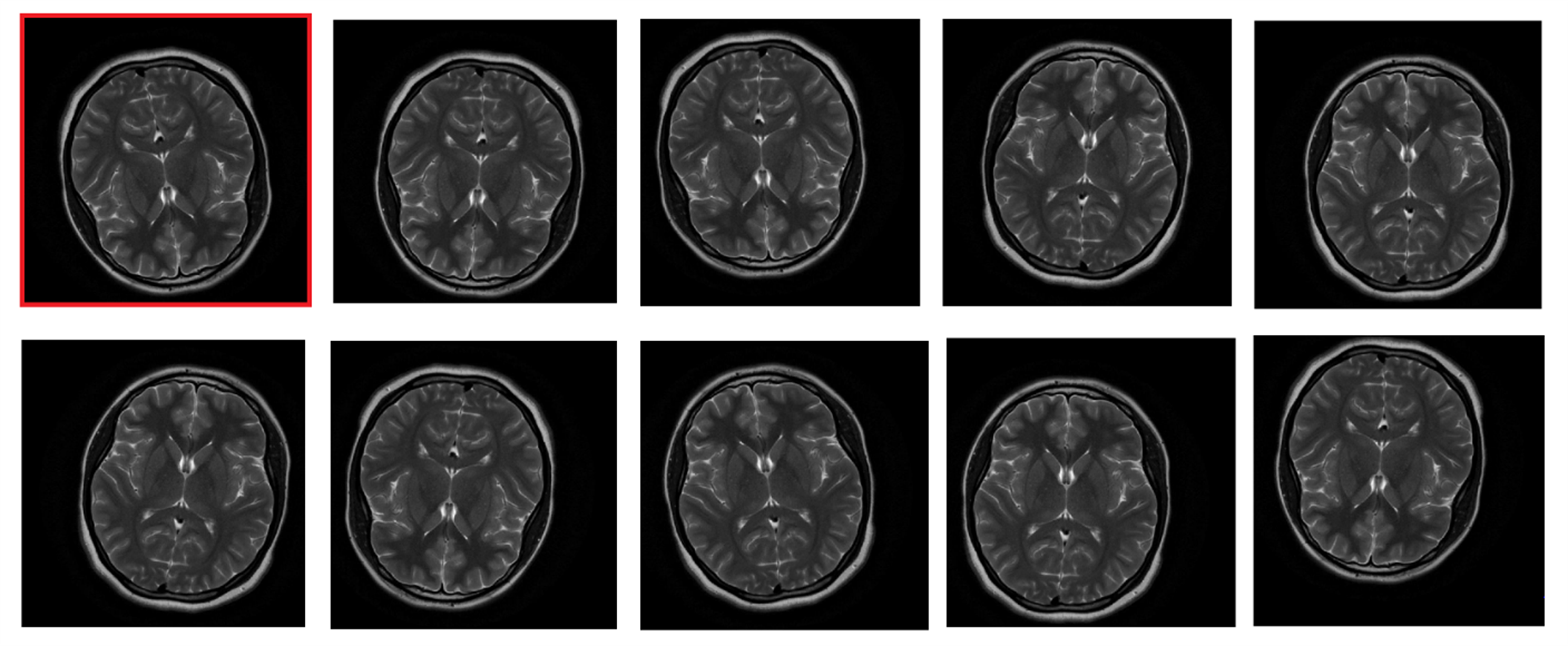 MRI image and augmented variants used during model training